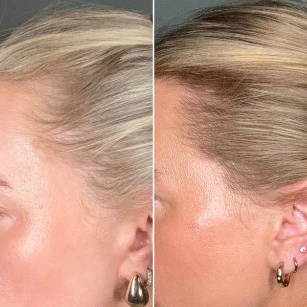 Hair recovery progress