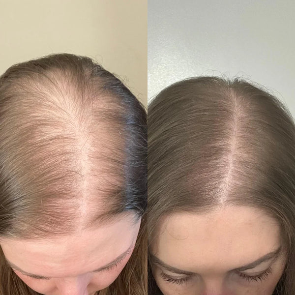 Hair recovery progress